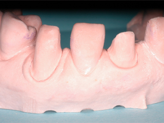 歯の型